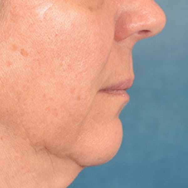 Lip Lift Before & After Gallery - Patient 191631 - Image 5