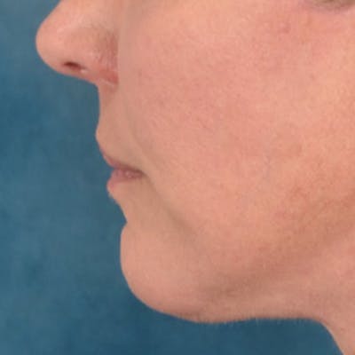 Lip Lift Before & After Gallery - Patient 191631 - Image 10