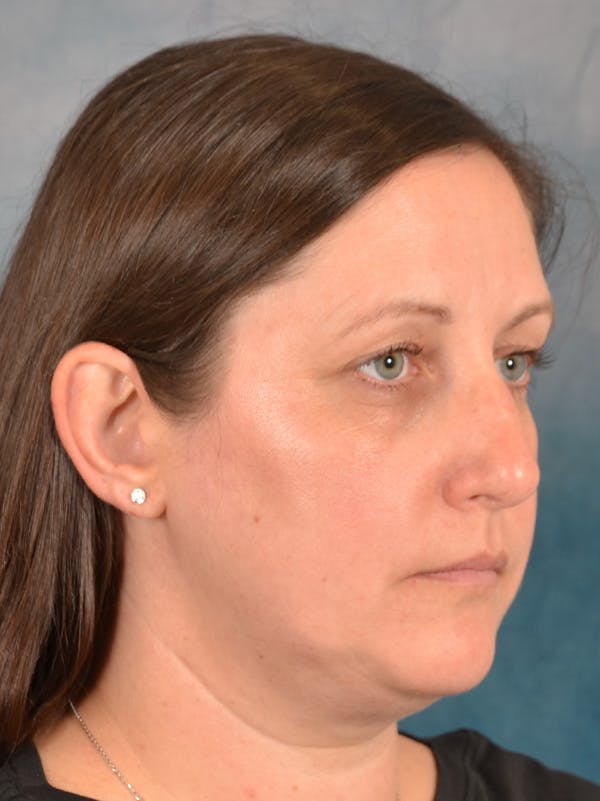 Rhinoplasty Before & After Gallery - Patient 392432 - Image 7