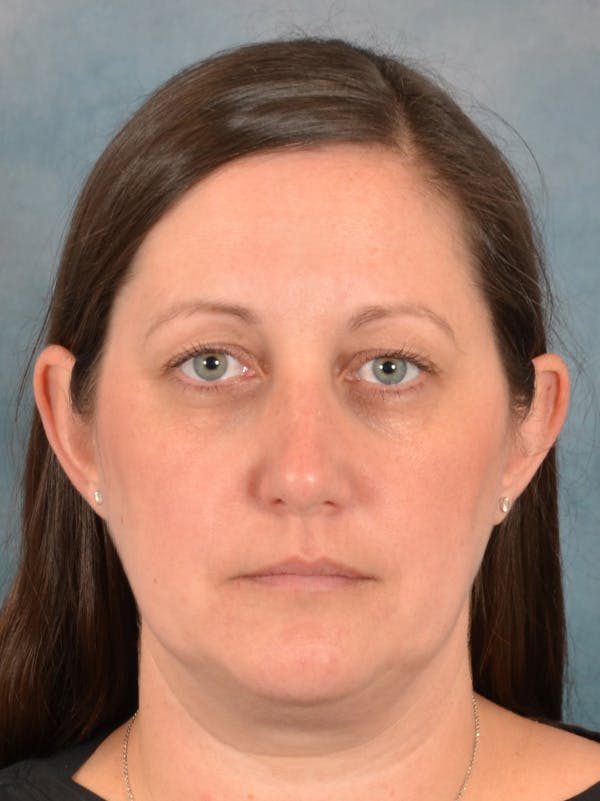 Rhinoplasty Before & After Gallery - Patient 392432 - Image 5
