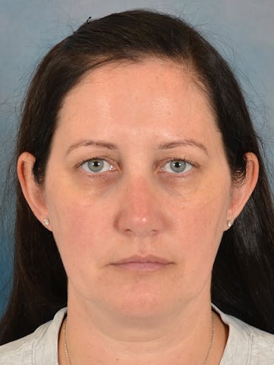 Rhinoplasty Before & After Gallery - Patient 392432 - Image 6