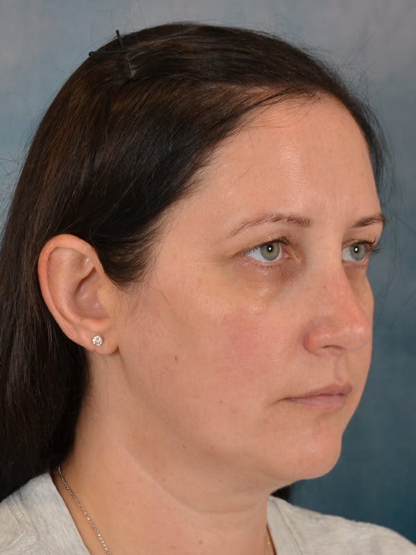Rhinoplasty Before & After Gallery - Patient 392432 - Image 8