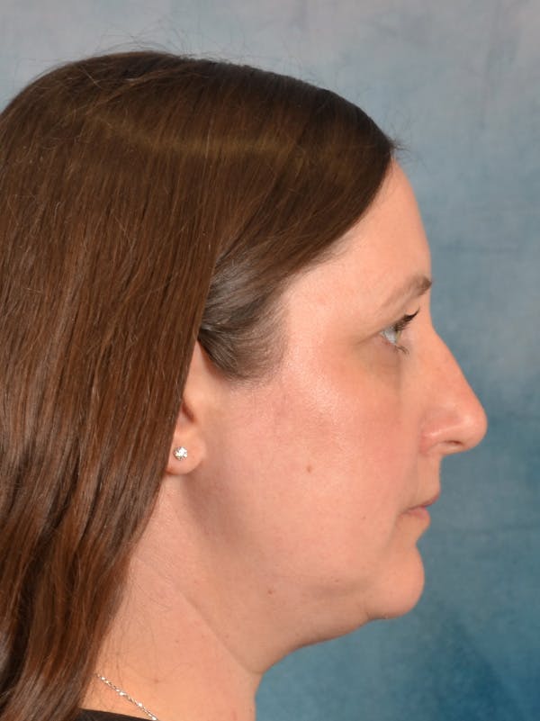 Rhinoplasty Before & After Gallery - Patient 392432 - Image 9