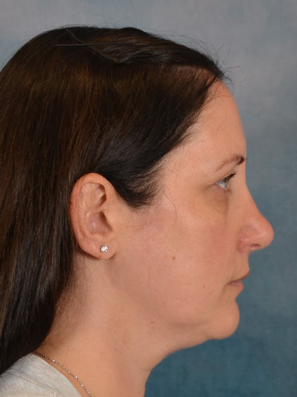 Rhinoplasty Before & After Gallery - Patient 392432 - Image 10