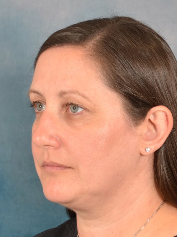 Rhinoplasty Before & After Gallery - Patient 392432 - Image 3