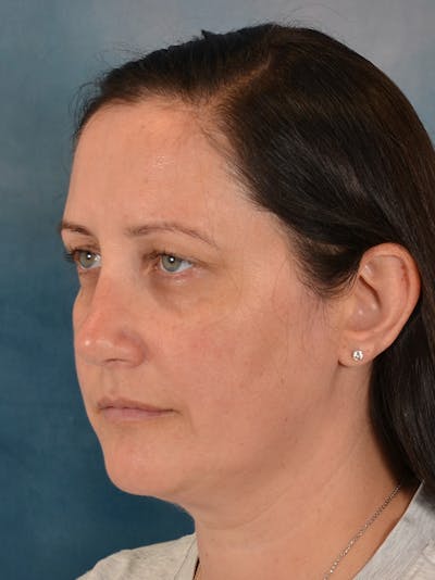 Rhinoplasty Before & After Gallery - Patient 392432 - Image 4