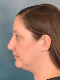 Rhinoplasty Before & After Gallery - Patient 392432 - Image 1
