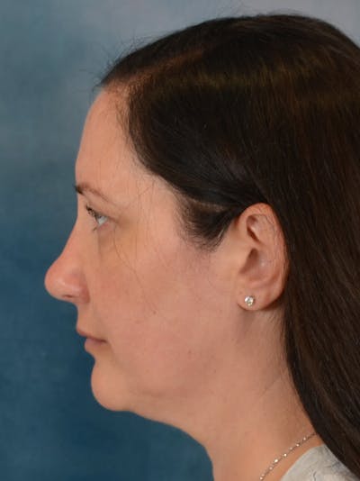 Rhinoplasty Before & After Gallery - Patient 392432 - Image 2