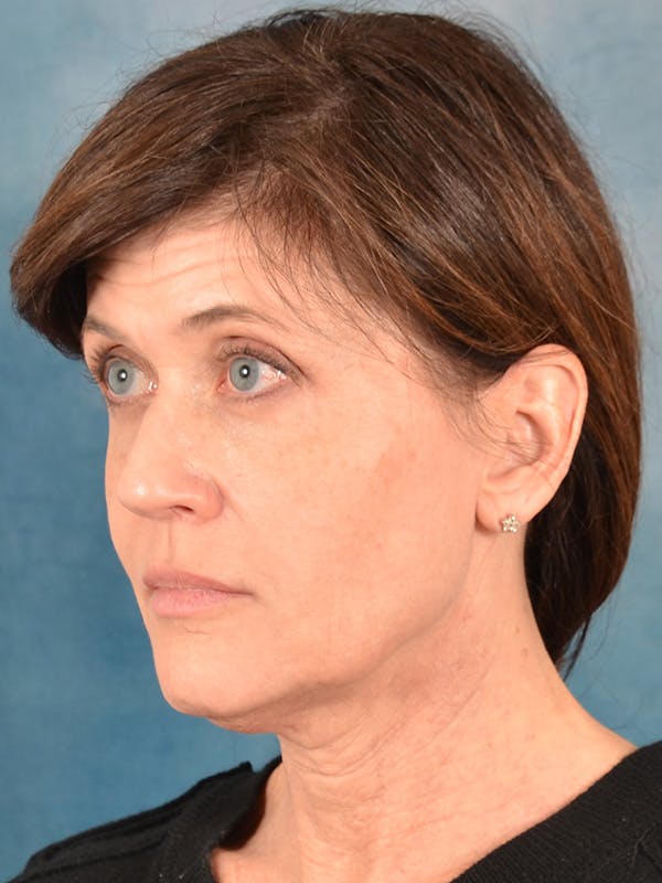 Laser Skin Resurfacing Before & After Gallery - Patient 189382 - Image 3