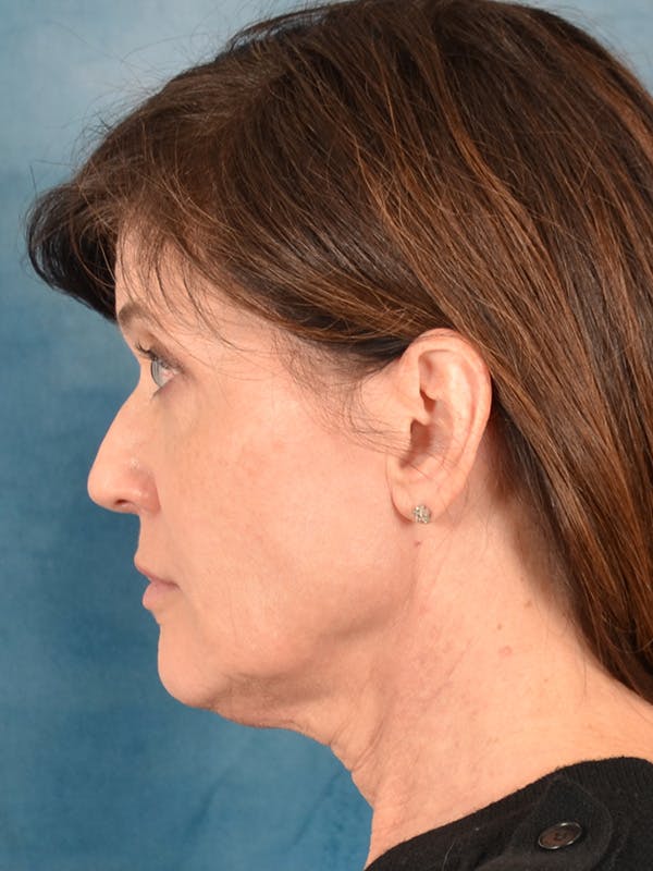 Laser Skin Resurfacing Before & After Gallery - Patient 189382 - Image 7