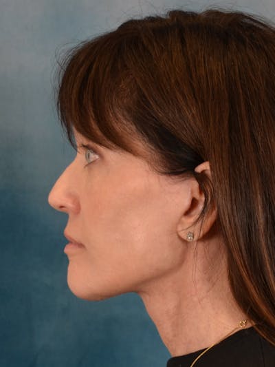 Laser Skin Resurfacing Before & After Gallery - Patient 189382 - Image 8
