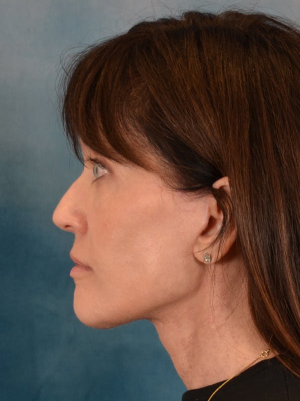 Laser Skin Resurfacing Before & After Gallery - Patient 189382 - Image 8