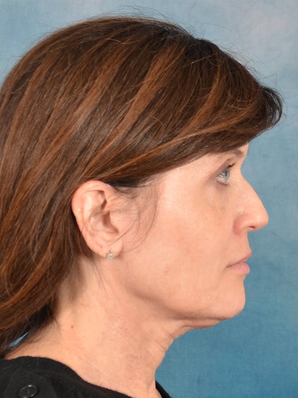Laser Skin Resurfacing Before & After Gallery - Patient 189382 - Image 9