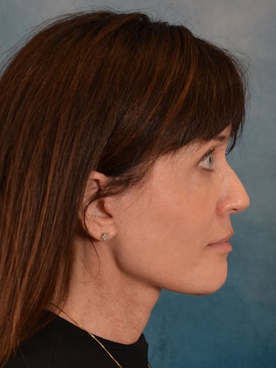 Laser Skin Resurfacing Before & After Gallery - Patient 189382 - Image 10