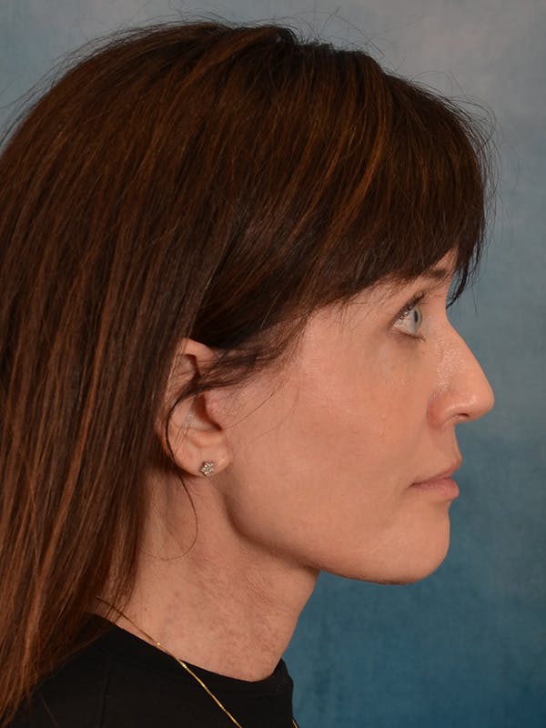 Laser Skin Resurfacing Before & After Gallery - Patient 189382 - Image 10