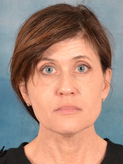 Laser Skin Resurfacing Before & After Gallery - Patient 189382 - Image 1