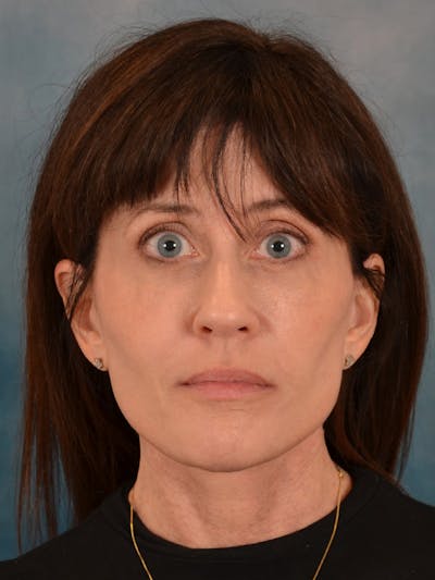 Laser Skin Resurfacing Before & After Gallery - Patient 189382 - Image 2