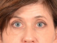 Eyelid Lift Before & After Gallery - Patient 263211 - Image 1