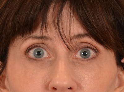 Eyelid Lift Before & After Gallery - Patient 263211 - Image 2