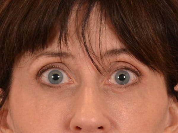 Eyelid Lift Before & After Gallery - Patient 263211 - Image 2