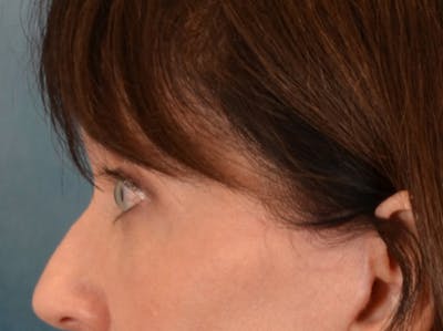 Eyelid Lift Before & After Gallery - Patient 263211 - Image 10