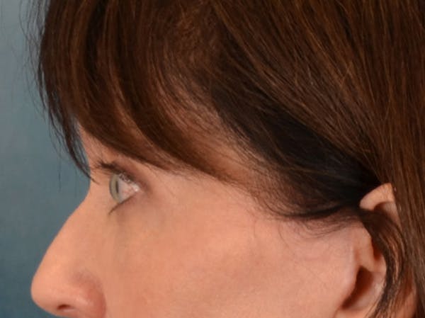 Eyelid Lift Before & After Gallery - Patient 263211 - Image 10