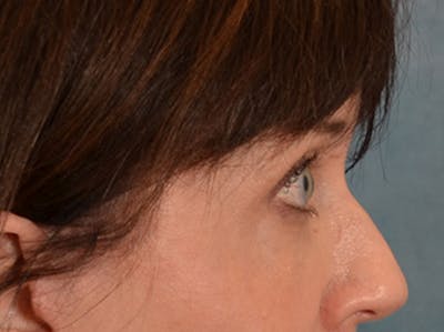Eyelid Lift Before & After Gallery - Patient 263211 - Image 6