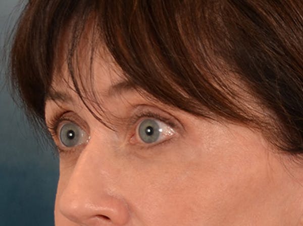 Eyelid Lift Before & After Gallery - Patient 263211 - Image 8
