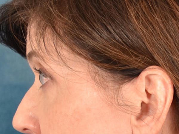 Eyelid Lift Before & After Gallery - Patient 263211 - Image 9