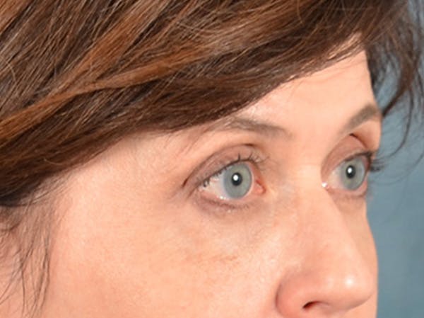 Eyelid Lift Before & After Gallery - Patient 263211 - Image 3