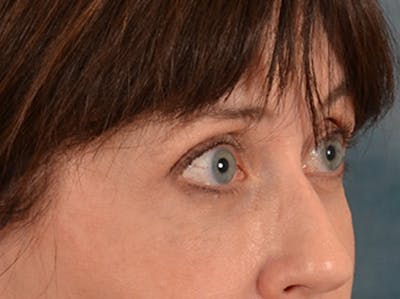 Eyelid Lift Before & After Gallery - Patient 263211 - Image 4