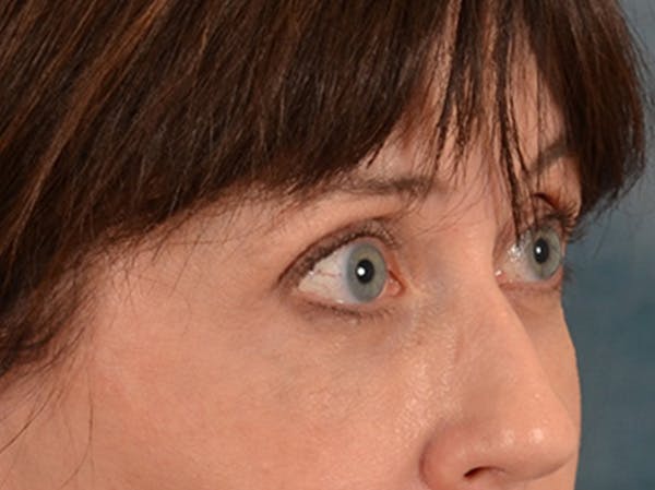 Eyelid Lift Before & After Gallery - Patient 263211 - Image 4