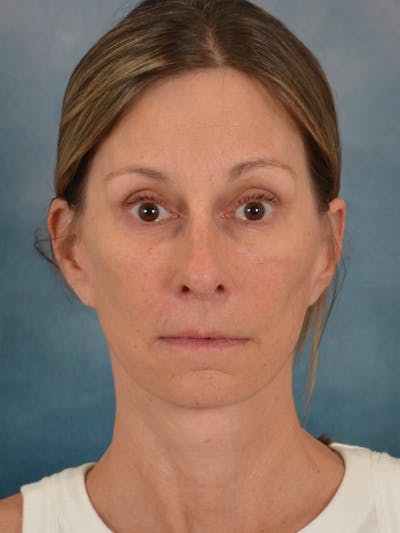 Fat Transfer Before & After Gallery - Patient 326569 - Image 2