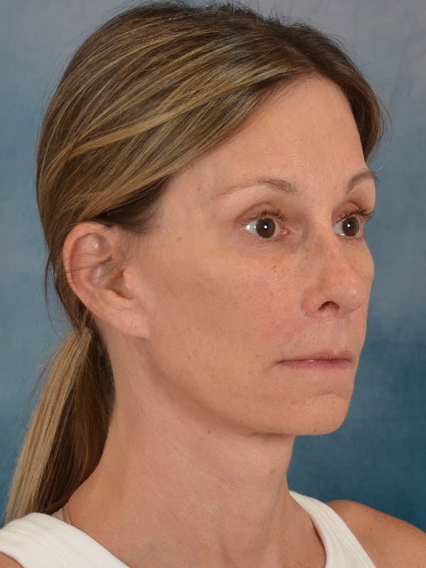 Fat Transfer Before & After Gallery - Patient 326569 - Image 8