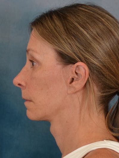 Fat Transfer Before & After Gallery - Patient 326569 - Image 6