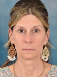 Brow Lift Before & After Gallery - Patient 196146 - Image 1