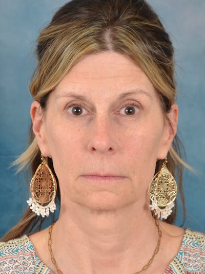 Fat Transfer Before & After Gallery - Patient 326569 - Image 1