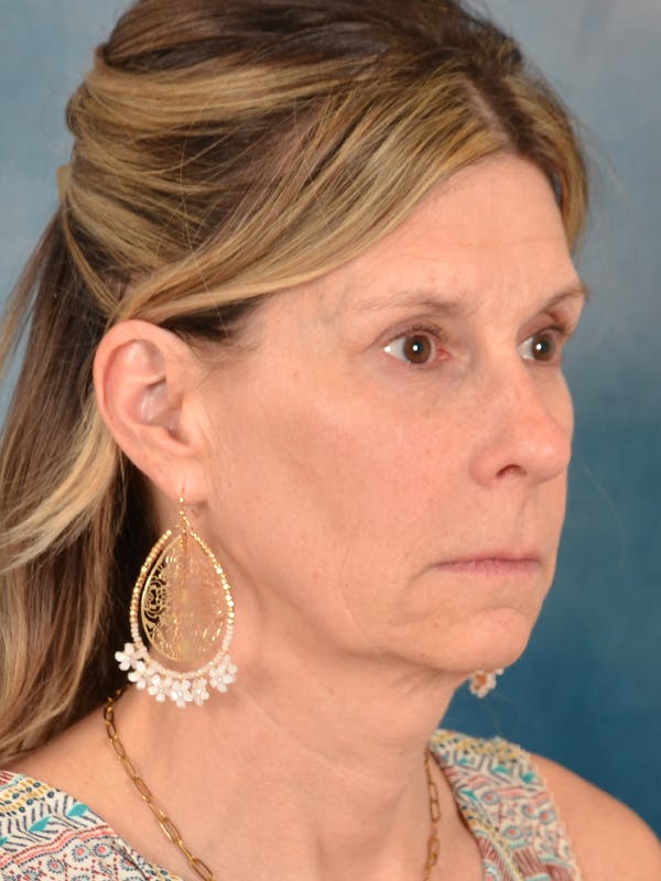 Fat Transfer Before & After Gallery - Patient 326569 - Image 7