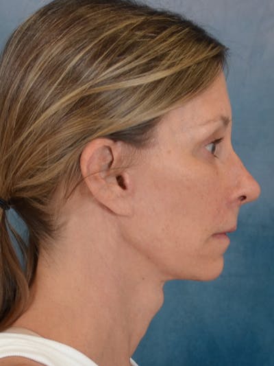 Fat Transfer Before & After Gallery - Patient 326569 - Image 10
