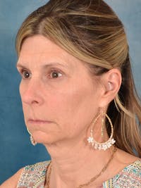 Deep Plane Facelift Before & After Gallery - Patient 111419 - Image 1