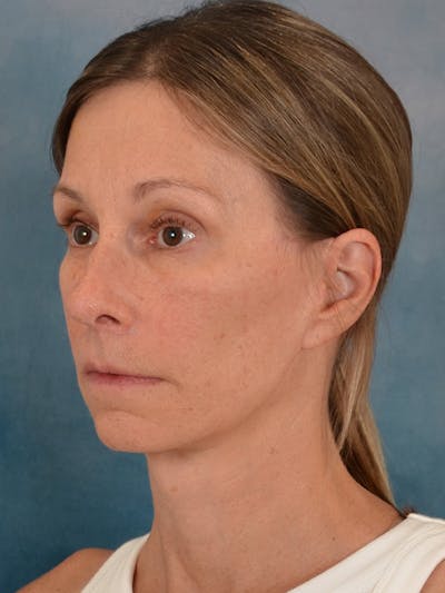 Deep Plane Facelift Before & After Gallery - Patient 111419 - Image 2
