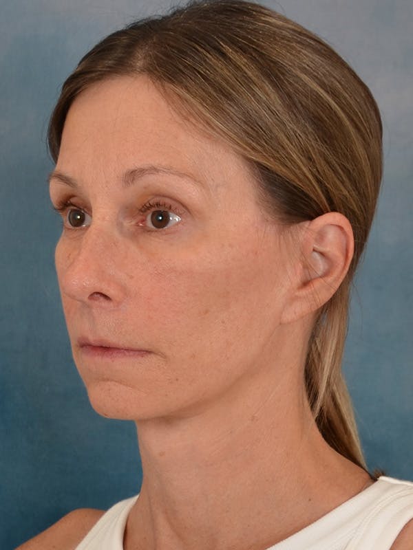 Fat Transfer Before & After Gallery - Patient 326569 - Image 4