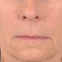 Lip Lift Before & After Gallery - Patient 358768 - Image 1
