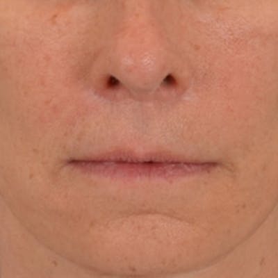 Lip Lift Before & After Gallery - Patient 358768 - Image 2