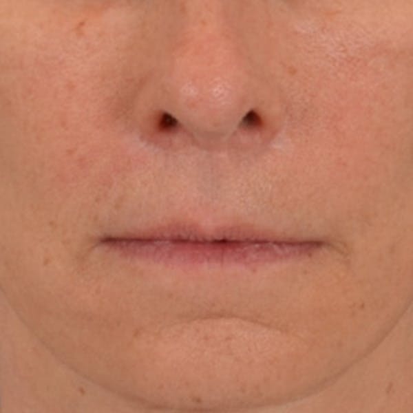 Lip Lift Before & After Gallery - Patient 358768 - Image 2