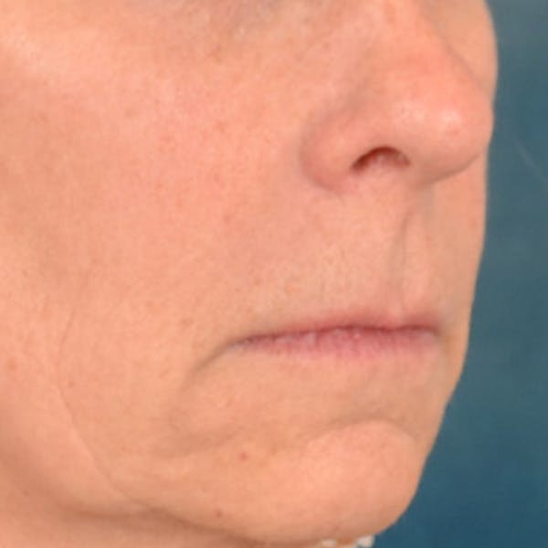 Lip Lift Before & After Gallery - Patient 358768 - Image 3