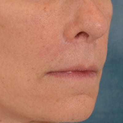 Lip Lift Before & After Gallery - Patient 358768 - Image 4