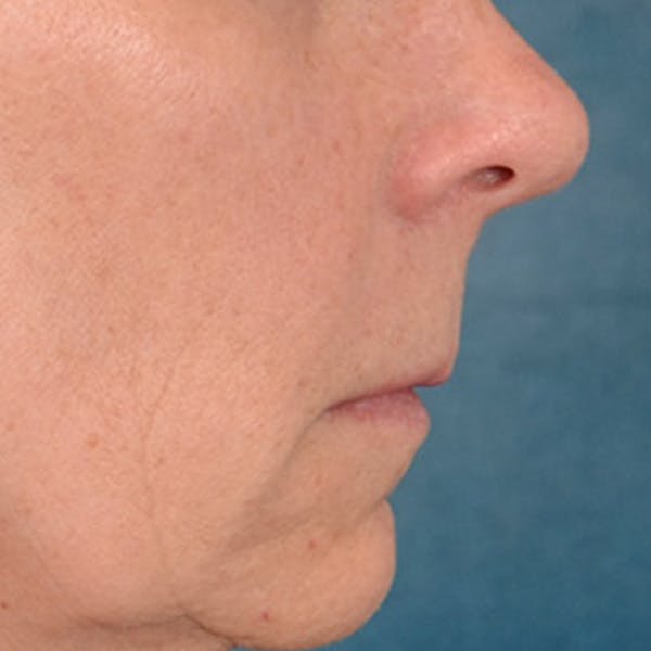 Lip Lift Before & After Gallery - Patient 358768 - Image 5