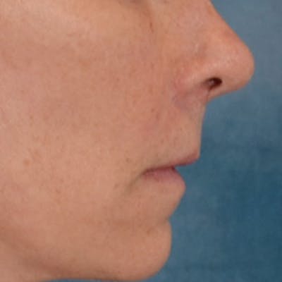Lip Lift Before & After Gallery - Patient 358768 - Image 6