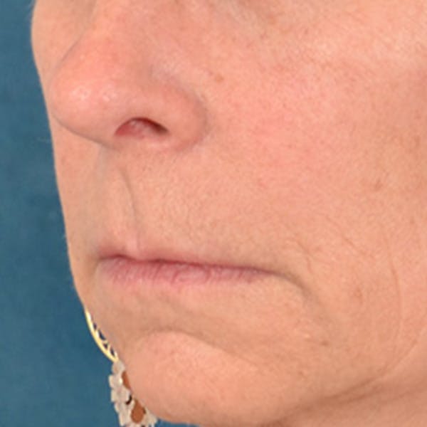 Lip Lift Before & After Gallery - Patient 358768 - Image 7